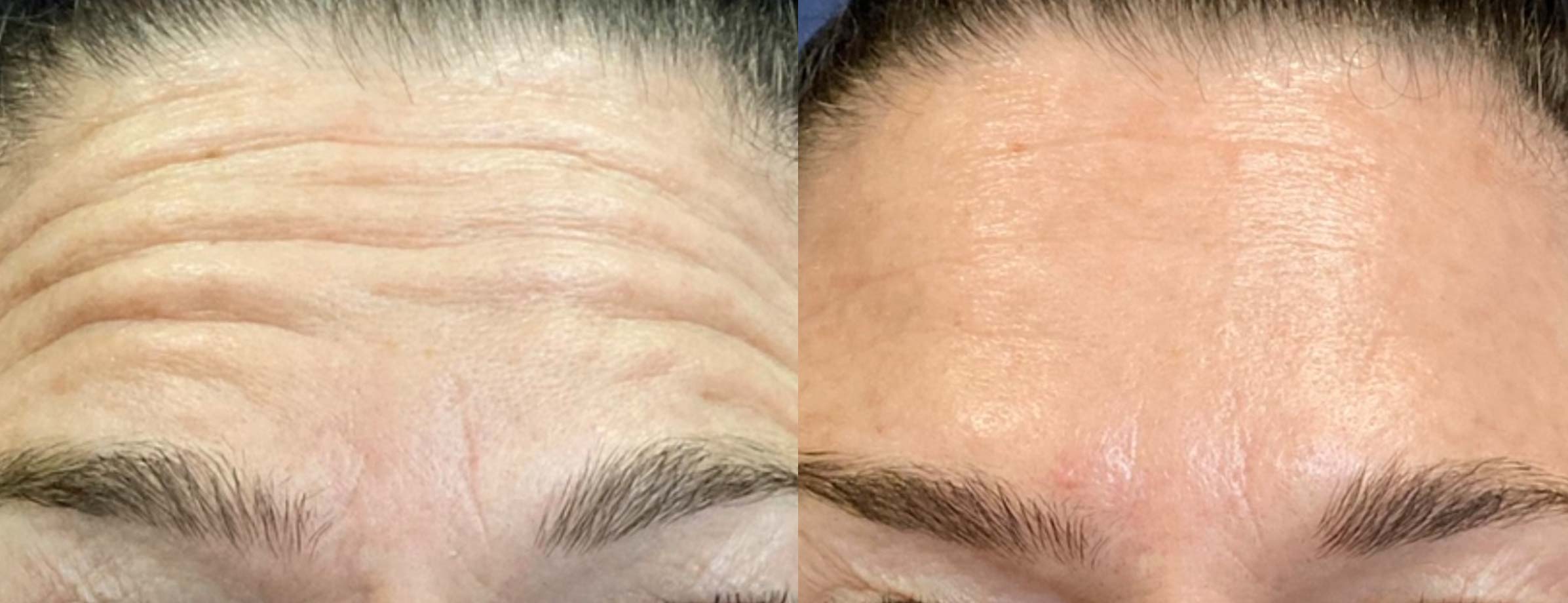 dr-valdez-botulinum-toxin-ba-three