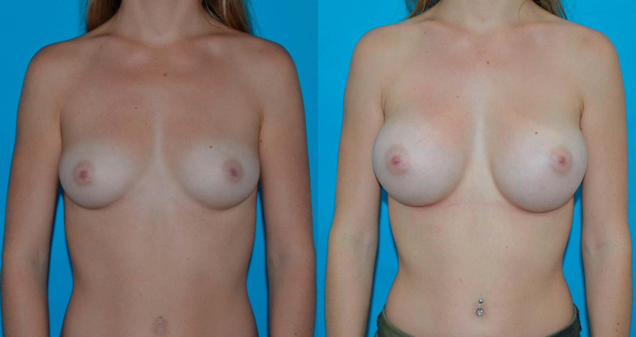 dr-valdez-breast-augmentation-_eighteen