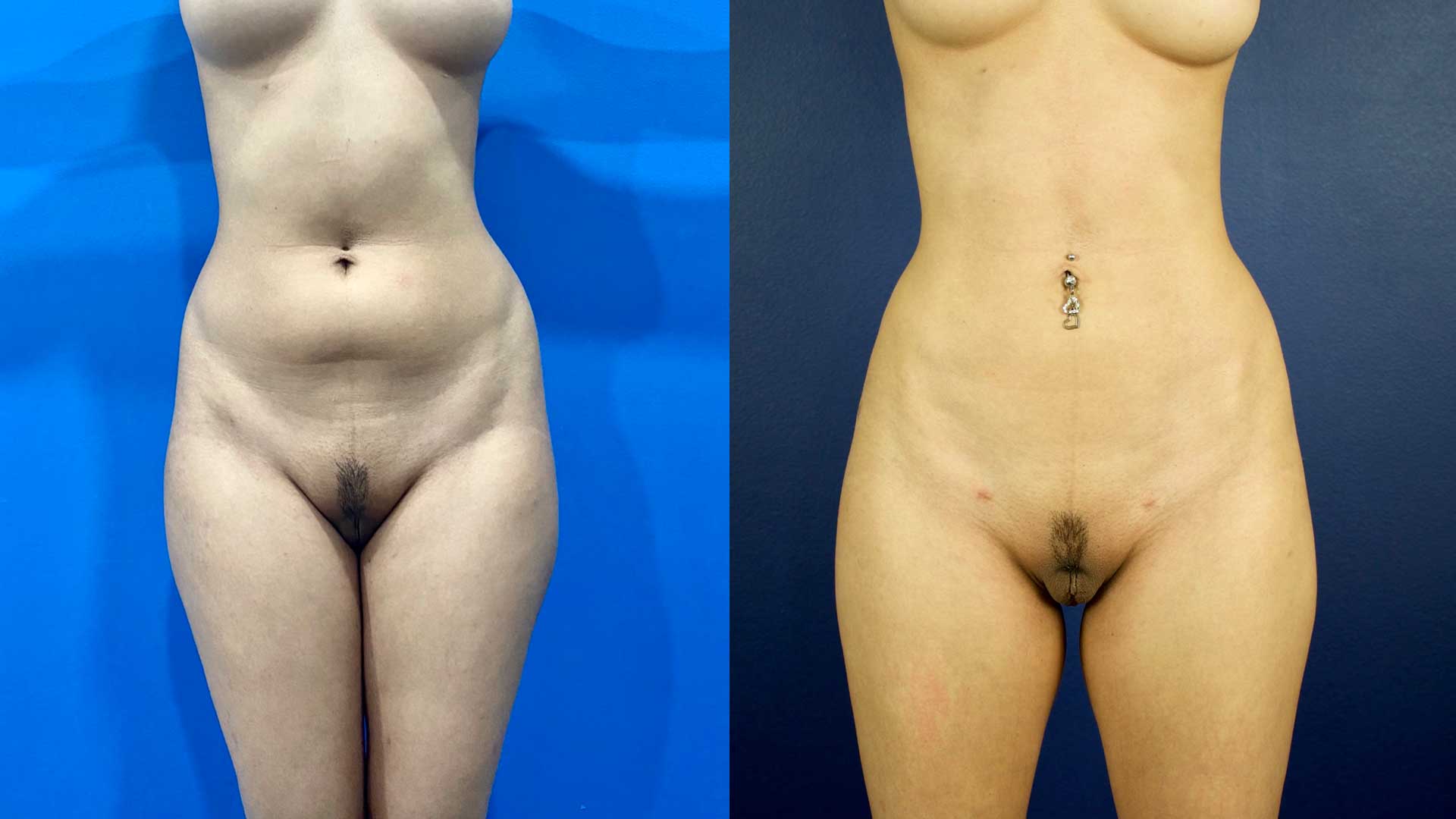 lipoescultura-ba-40