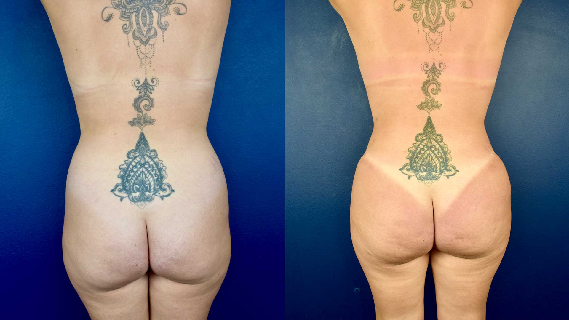 tummy-tuck-ba-27