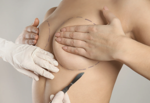 breast augmentation vs implants
